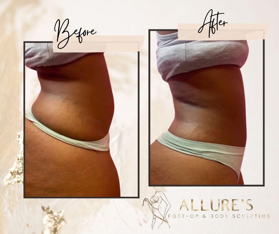 Allure’s Post Op & Body Sculpting Jacksonville, FL Nextdoor