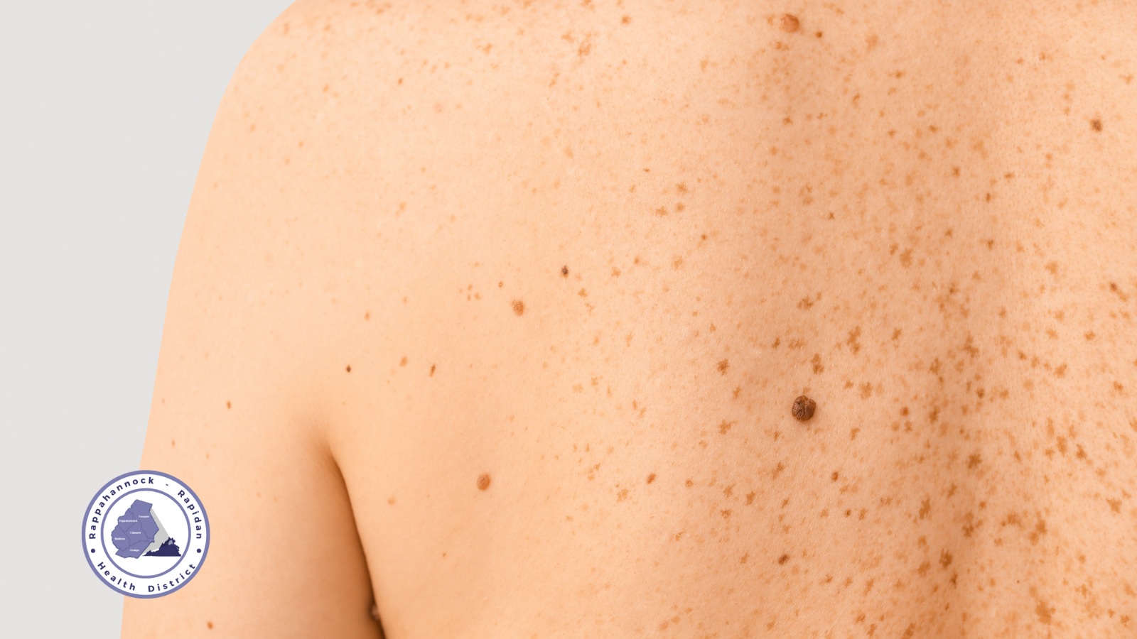 A Common Location For Melanoma In Men Is On The Back And In Women The